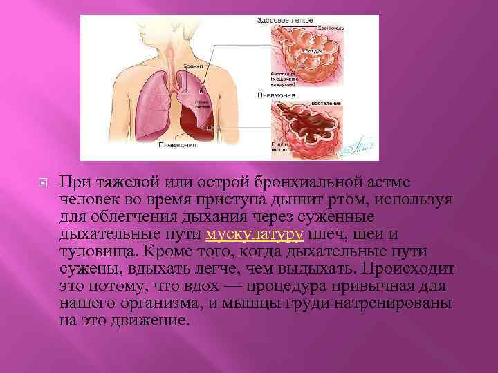  При тяжелой или острой бронхиальной астме человек во время приступа дышит ртом, используя