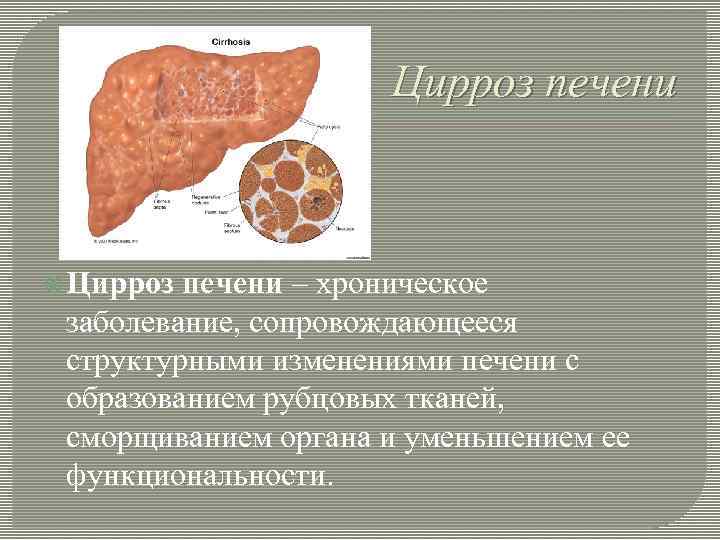 Цирроз печени – хроническое заболевание, сопровождающееся структурными изменениями печени с образованием рубцовых тканей, сморщиванием