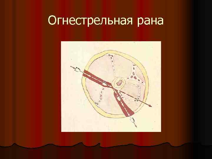Огнестрельная рана 