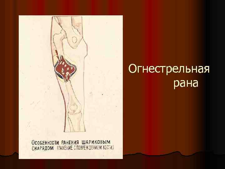 Огнестрельная рана 