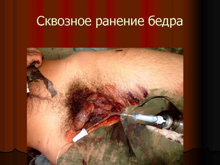 Сквозное ранение бедра 