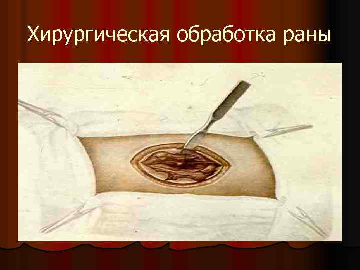 Хирургическая обработка раны 