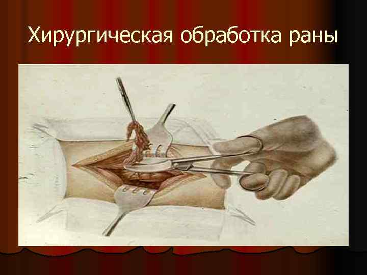Хирургическая обработка раны 