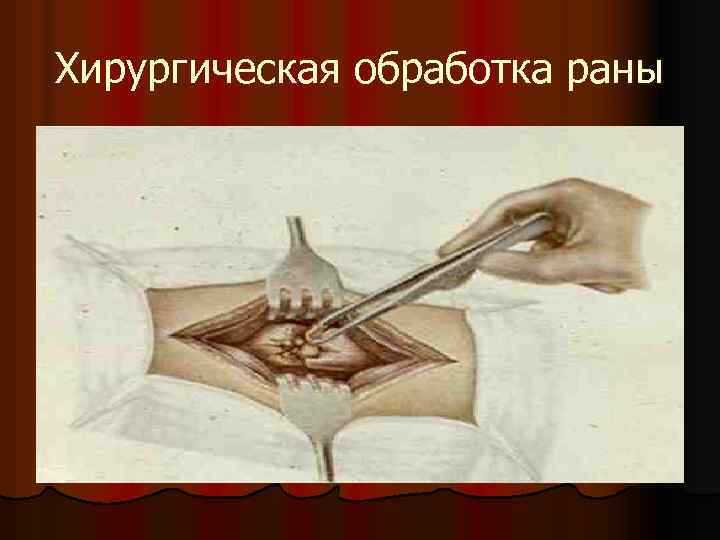 Хирургическая обработка раны 