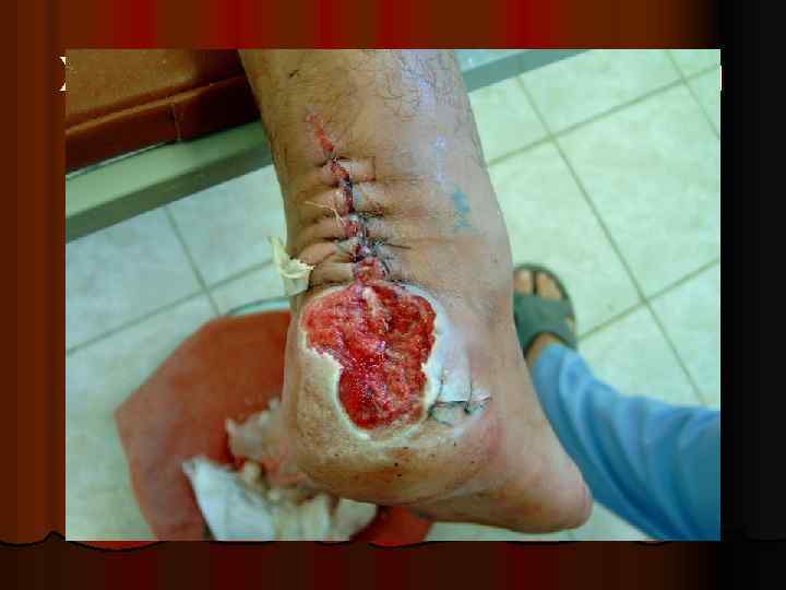 Хирургическая обработка раны 