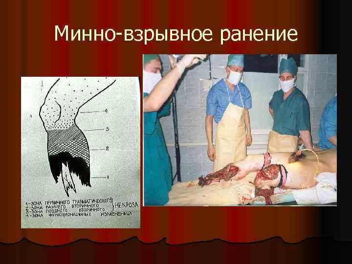 Минно-взрывное ранение 