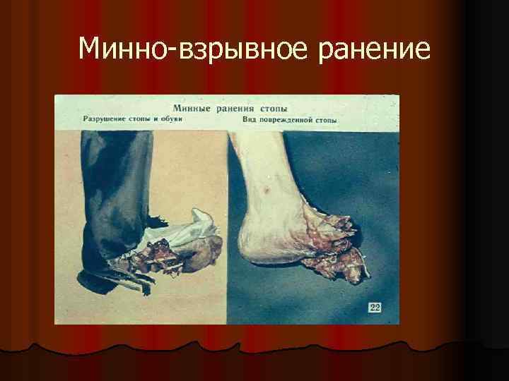 Минно-взрывное ранение 