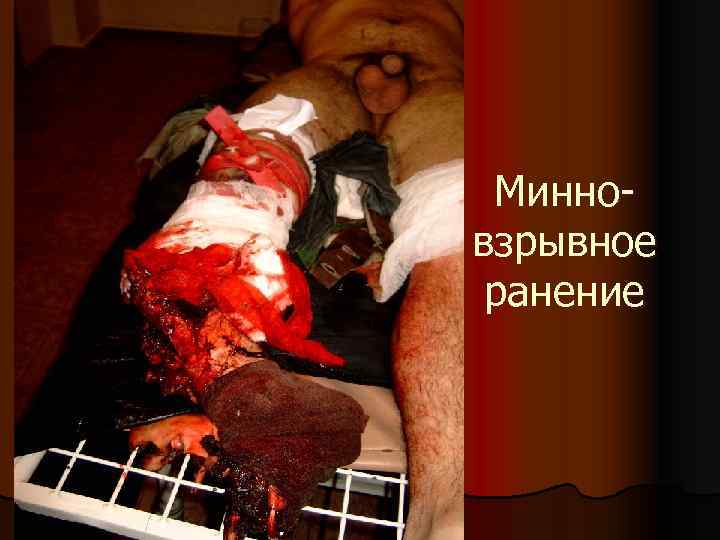 Минновзрывное ранение 