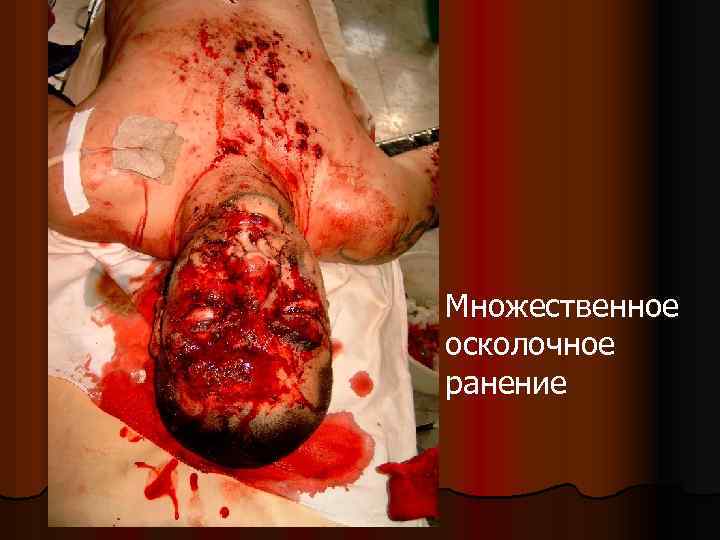 l Множественное осколочное ранение 