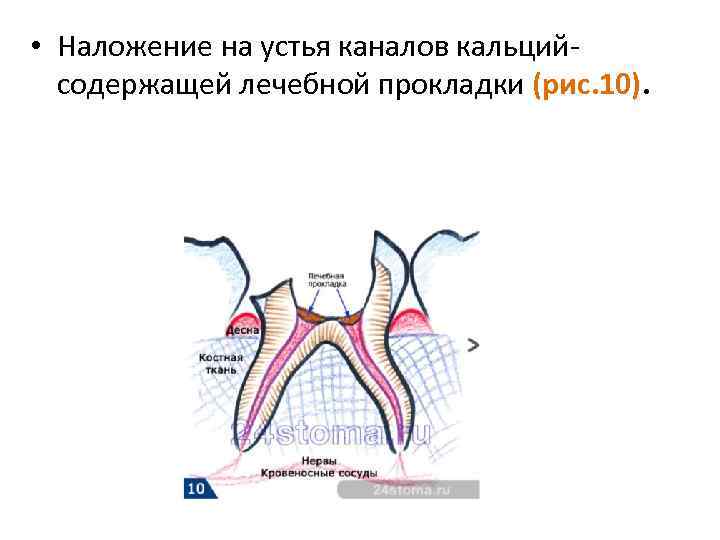 Схема наложения лечебных прокладок