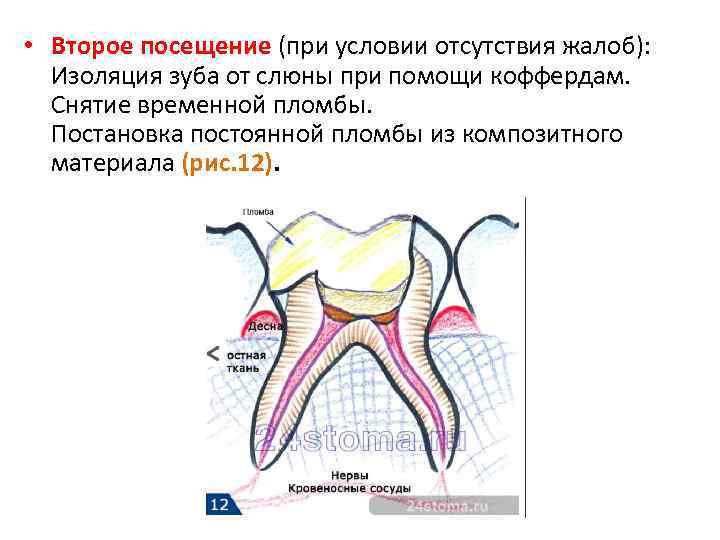  • Второе посещение (при условии отсутствия жалоб): Изоляция зуба от слюны при помощи