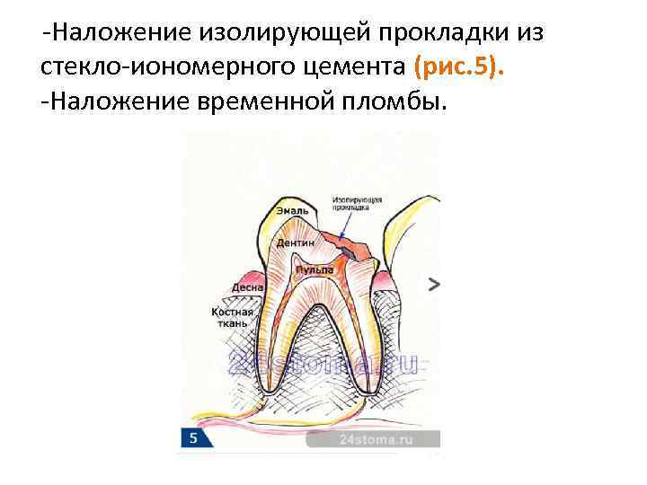  -Наложение изолирующей прокладки из стекло-иономерного цемента (рис. 5). -Наложение временной пломбы. 