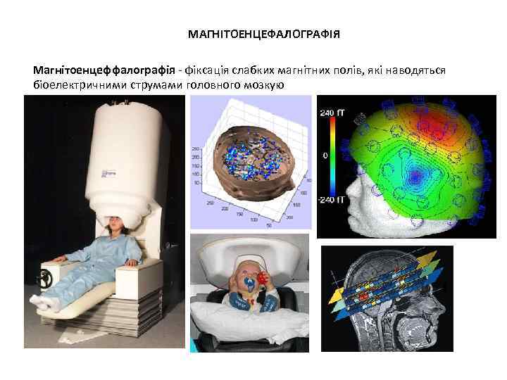 МАГНІТОЕНЦЕФАЛОГРАФІЯ Магнітоенцеффалографія - фіксація слабких магнітних полів, які наводяться біоелектричними струмами головного мозкую 