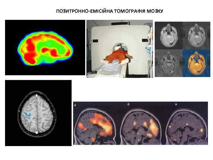 ПОЗИТРОННО-ЕМІСІЙНА ТОМОГРАФІЯ МОЗКУ 