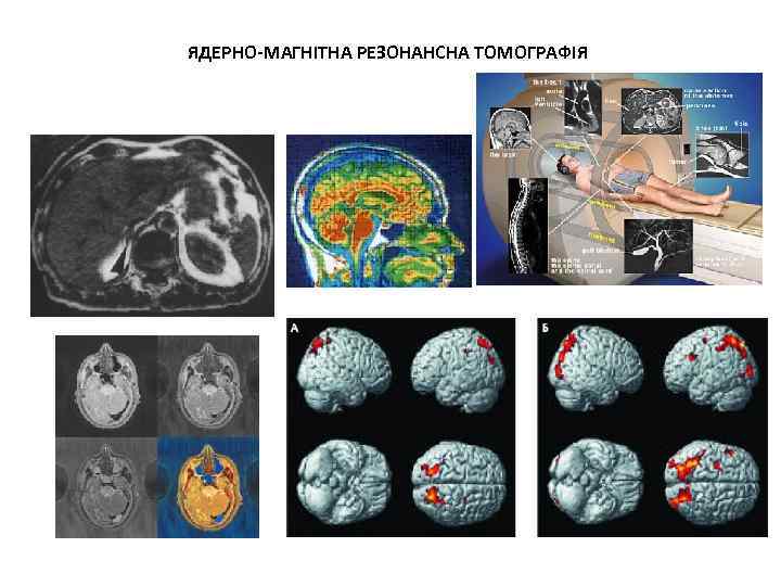 ЯДЕРНО-МАГНІТНА РЕЗОНАНСНА ТОМОГРАФІЯ 