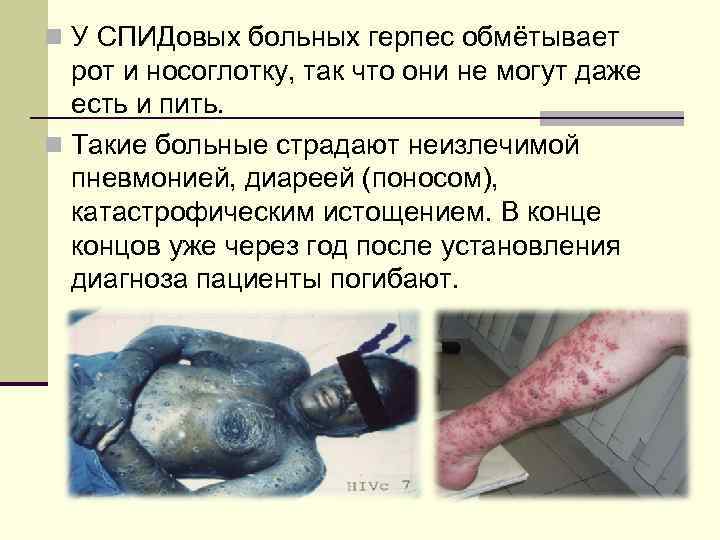 n У СПИДовых больных герпес обмётывает рот и носоглотку, так что они не могут