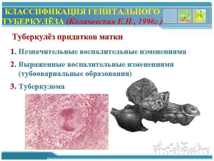 КЛАССИФИКАЦИЯ ГЕНИТАЛЬНОГО ТУБЕРКУЛЁЗА (Колачевская Е. Н. , 1996 г. ) Туберкулёз придатков матки 1.