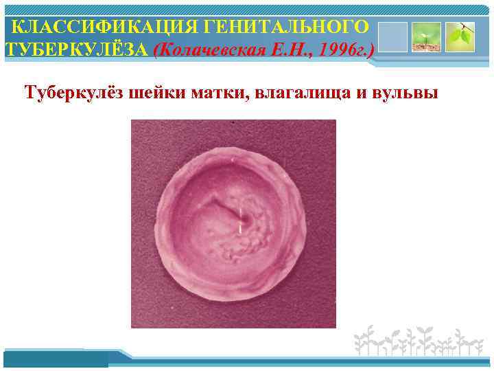 КЛАССИФИКАЦИЯ ГЕНИТАЛЬНОГО ТУБЕРКУЛЁЗА (Колачевская Е. Н. , 1996 г. ) Туберкулёз шейки матки, влагалища