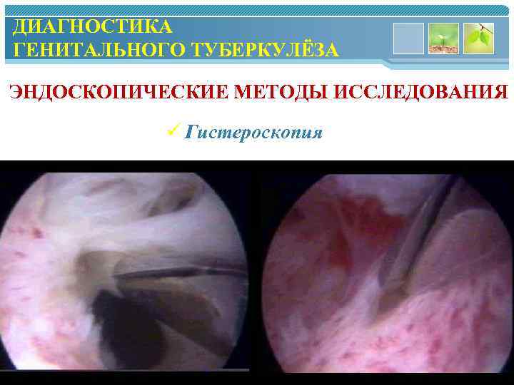 Схема методы диагностики туберкулеза