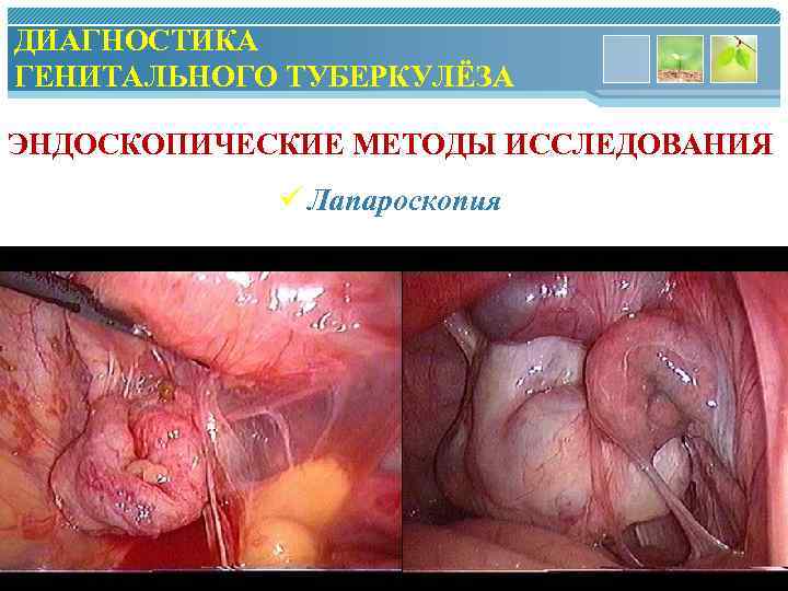 ДИАГНОСТИКА ГЕНИТАЛЬНОГО ТУБЕРКУЛЁЗА ЭНДОСКОПИЧЕСКИЕ МЕТОДЫ ИССЛЕДОВАНИЯ ü Лапароскопия www. themegallery. com 