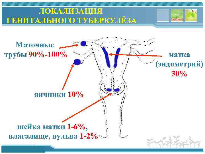 ЛОКАЛИЗАЦИЯ ГЕНИТАЛЬНОГО ТУБЕРКУЛЁЗА Маточные трубы 90%-100% яичники 10% шейка матки 1 -6%, влагалище, вульва