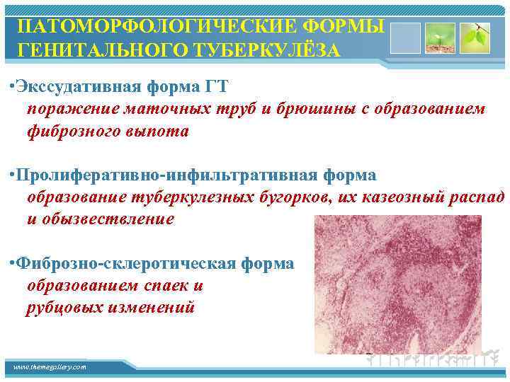 ПАТОМОРФОЛОГИЧЕСКИЕ ФОРМЫ ГЕНИТАЛЬНОГО ТУБЕРКУЛЁЗА • Экссудативная форма ГТ поражение маточных труб и брюшины с