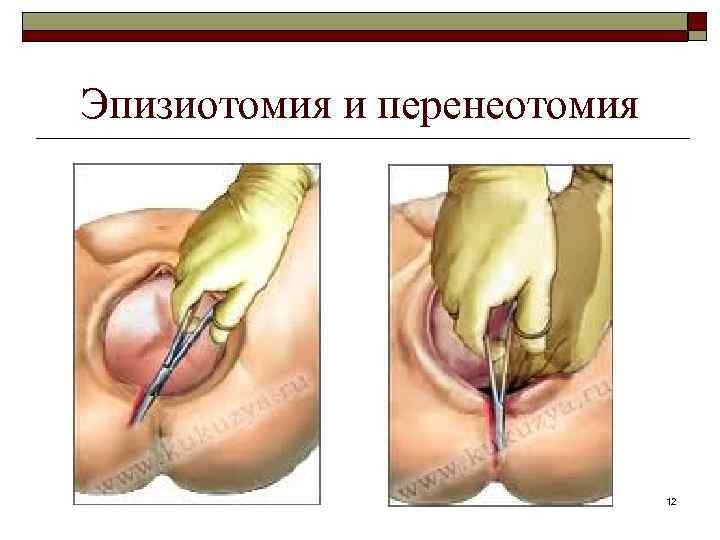 Эпизиотомия и перенеотомия 12 