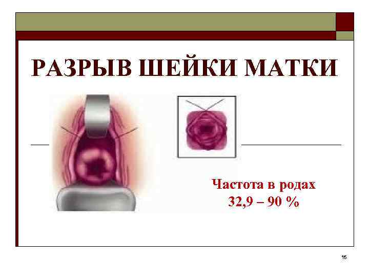 РАЗРЫВ ШЕЙКИ МАТКИ Частота в родах 32, 9 – 90 % 15 