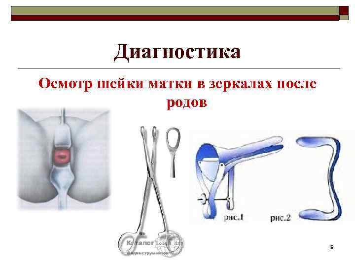 Диагностика Осмотр шейки матки в зеркалах после родов 19 