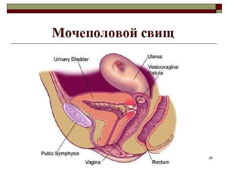 Мочеполовой свищ 23 