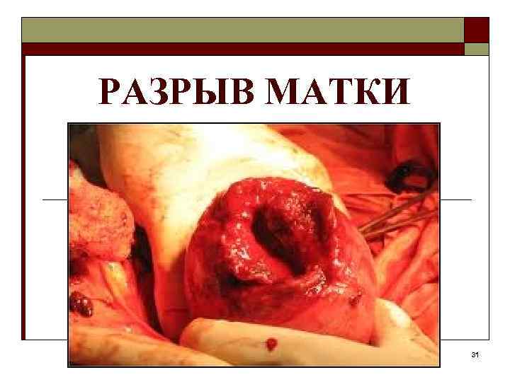 РАЗРЫВ МАТКИ 31 