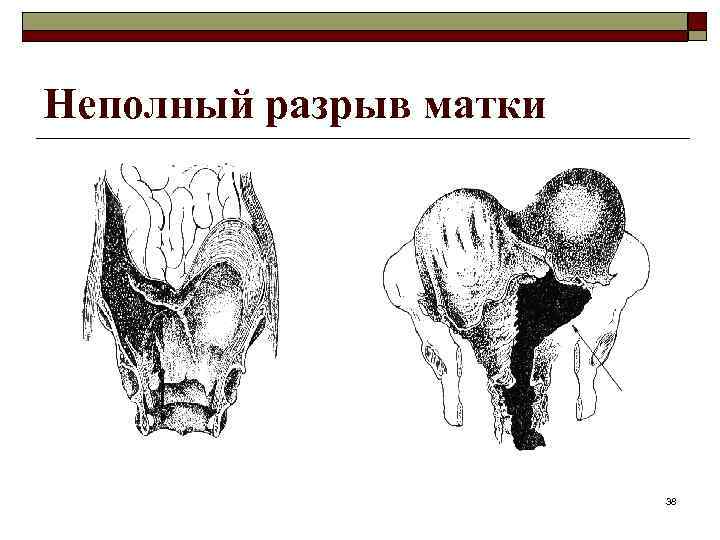 Неполный разрыв матки 38 