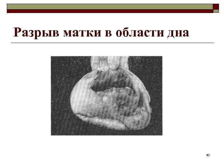 Разрыв матки в области дна 40 