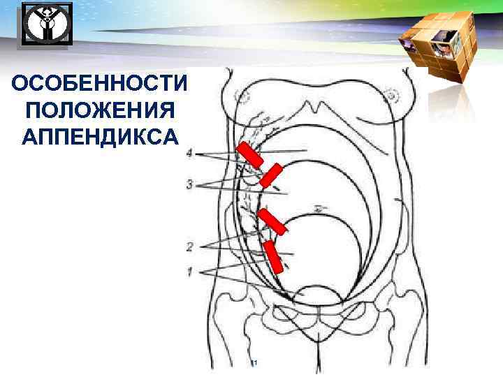 LOGO ОСОБЕННОСТИ ПОЛОЖЕНИЯ АППЕНДИКСА 11 