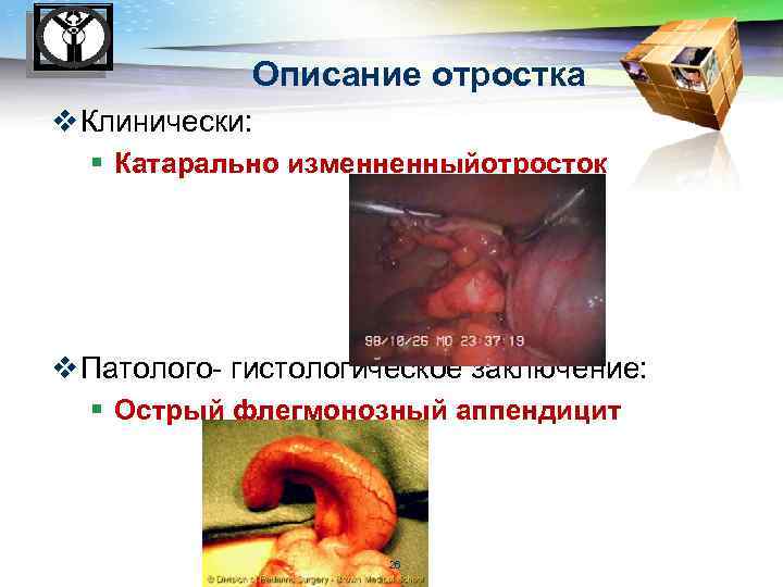 LOGO Описание отростка v Клинически: § Катарально изменненныйотросток v Патолого- гистологическое заключение: § Острый