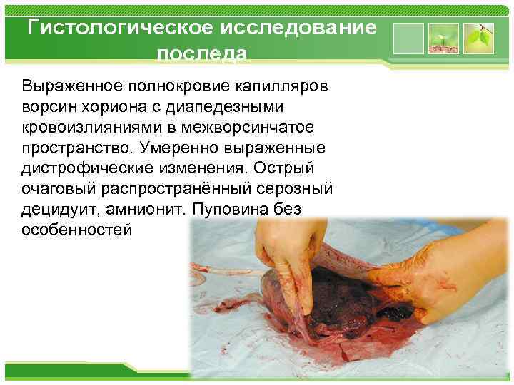 Гистологическое исследование последа Выраженное полнокровие капилляров ворсин хориона с диапедезными кровоизлияниями в межворсинчатое пространство.