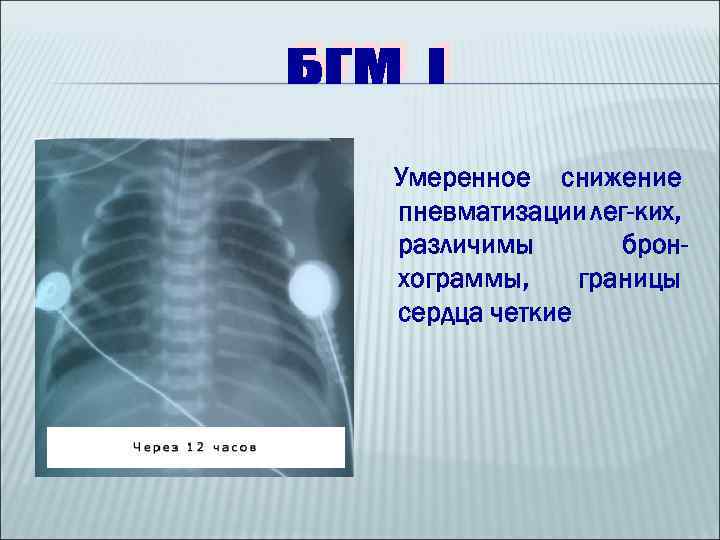 Умеренное снижение пневматизации лег-ких, различимы бронхограммы, границы сердца четкие 