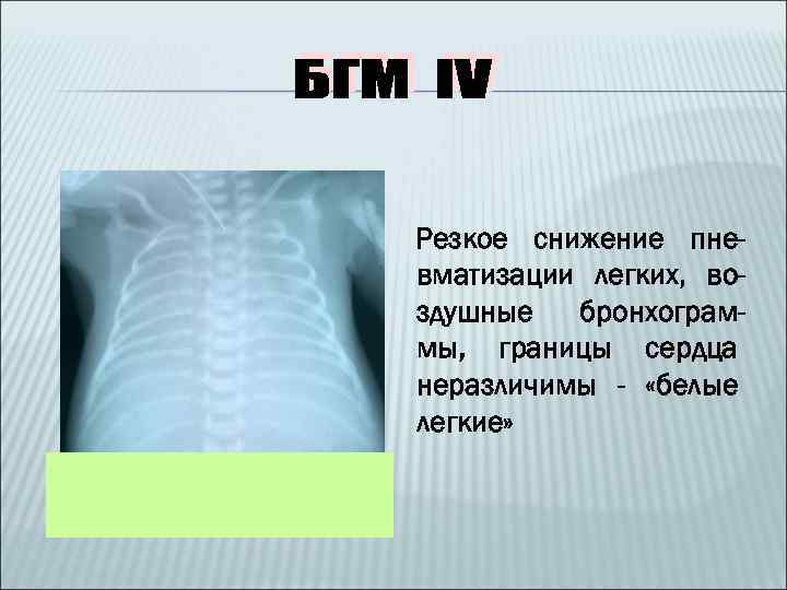 Резкое снижение пневматизации легких, воздушные бронхограммы, границы сердца неразличимы - «белые легкие» 