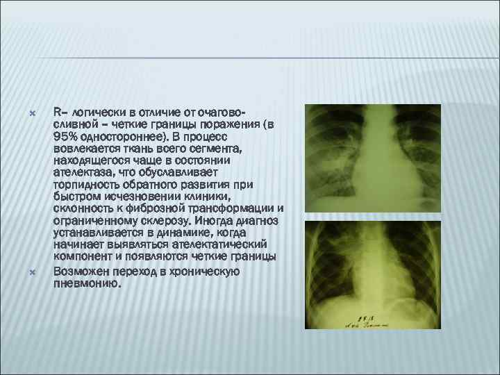  R– логически в отличие от очаговосливной – четкие границы поражения (в 95% одностороннее).