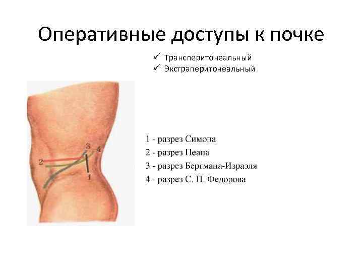 Оперативные доступы к почке ü Трансперитонеальный ü Экстраперитонеальный 