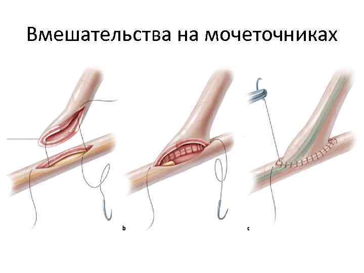 Вмешательства на мочеточниках 