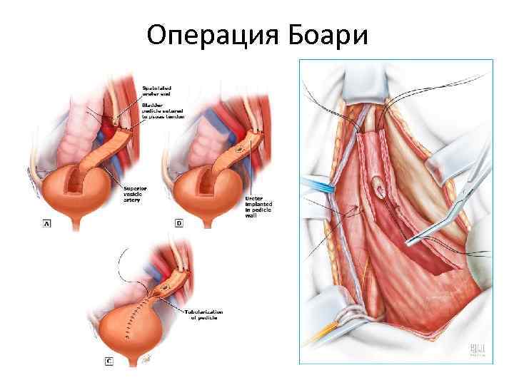 Операция Боари 