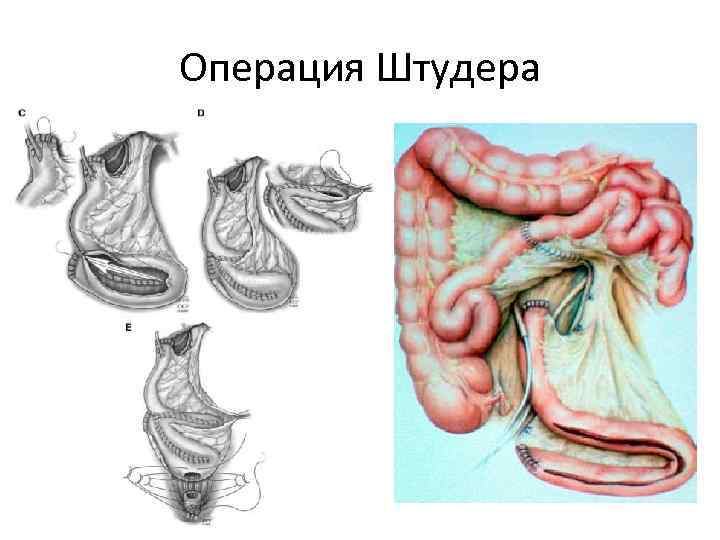 Операция Штудера 