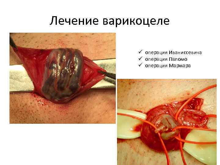 Лечение варикоцеле ü операция Иваниссевича ü операция Паломо ü операция Мармара 