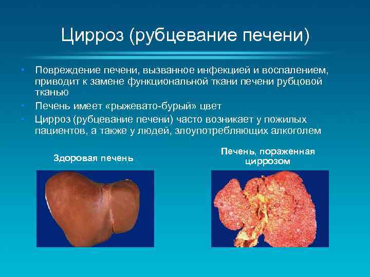 Цирроз (рубцевание печени) • Повреждение печени, вызванное инфекцией и воспалением, приводит к замене функциональной