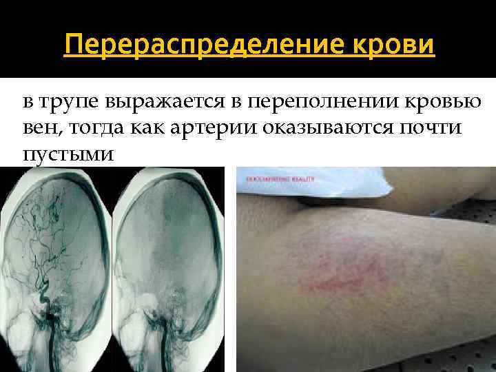 Перераспределение крови в трупе выражается в переполнении кровью вен, тогда как артерии оказываются почти