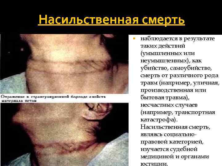 Насильственная смерть наблюдается в результате таких действий (умышленных или неумышленных), как убийство, самоубийство, смерть