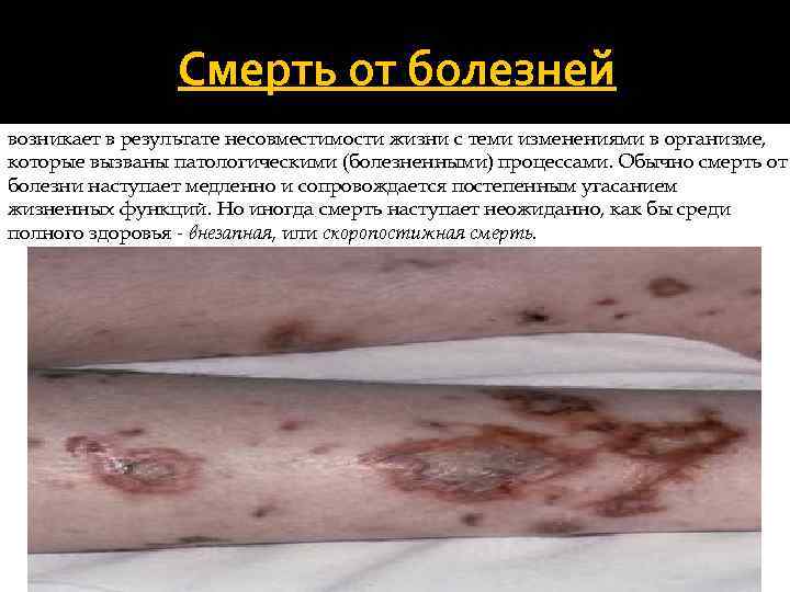 Смерть от болезней возникает в результате несовместимости жизни с теми изменениями в организме, которые