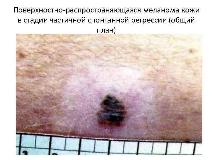 Поверхностно-распространяющаяся меланома кожи в стадии частичной спонтанной регрессии (общий план) 
