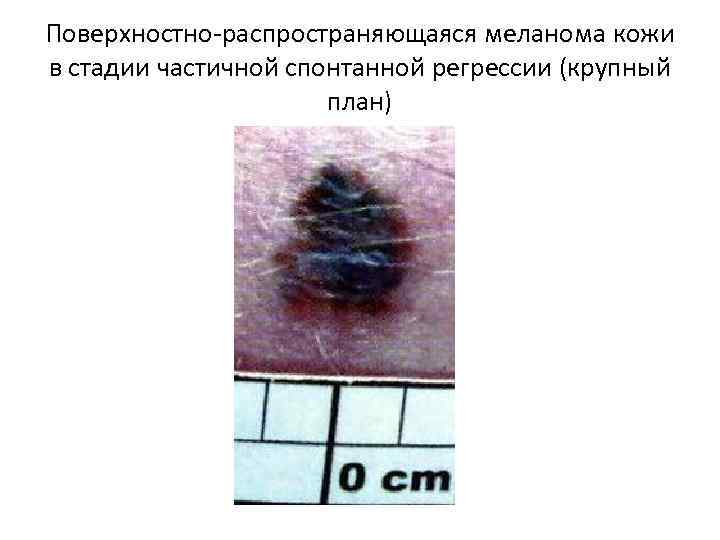 Поверхностно-распространяющаяся меланома кожи в стадии частичной спонтанной регрессии (крупный план) 